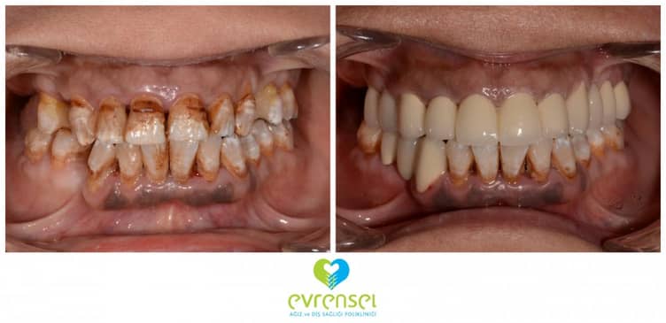 Slider image (10) Evrensel Dental Clinic in Ankara Turkey